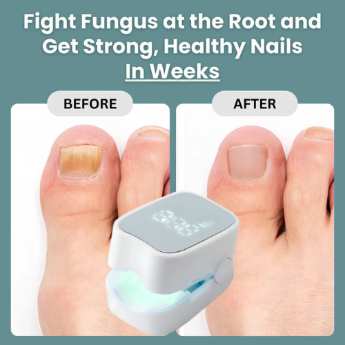 Angler Sway™ - Nail Fungus Laser Device