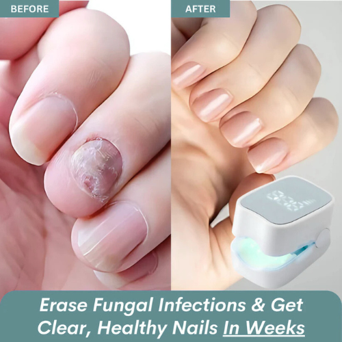 Angler Sway™ - Nail Fungus Laser Device