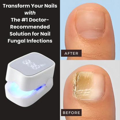 Angler Sway™ - Nail Fungus Laser Device
